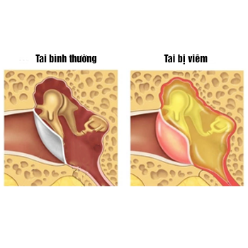 Biến chứng viêm xoang ở tai