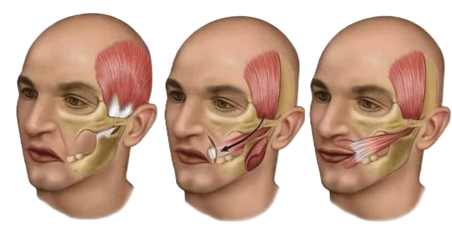 Co thắt nửa mặt sau liệt mặt