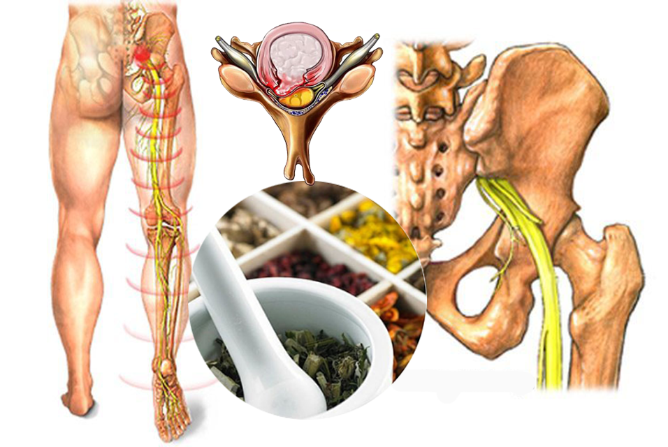 Bài thuốc Đông y điều trị đau thần kinh tọa