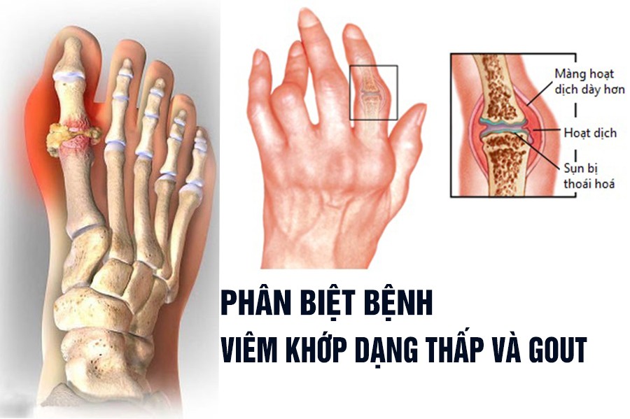 Viêm Khớp Dạng Thấp và Gout giống và khác nhau điểm nào?