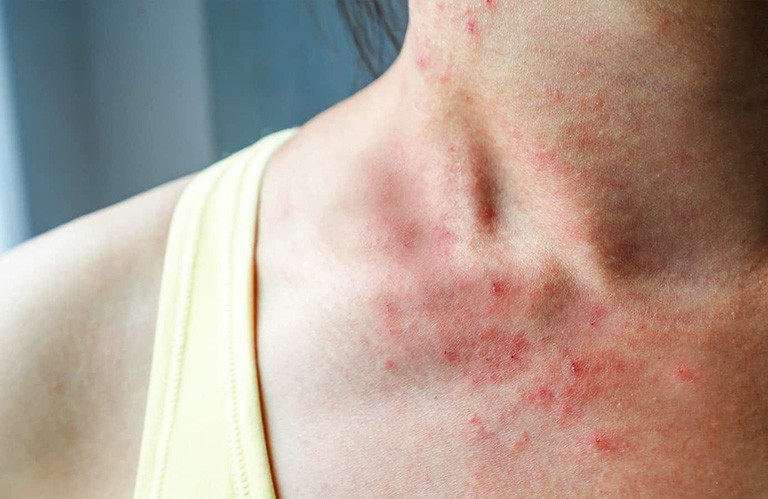 Dị ứng thời tiết nỗi ám ảnh ngày giao mùa