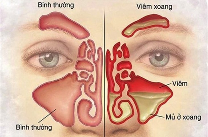 Viêm xoang trán: Nguyên nhân, triệu chứng và các phương pháp điều trị