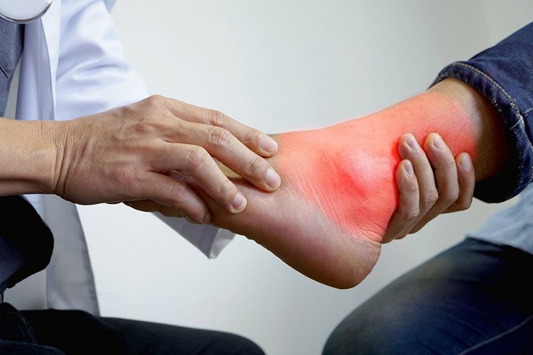 Thoái hóa khớp do bệnh gout (gút)